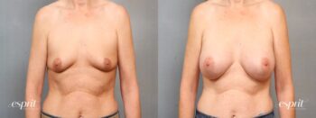 Case 1530 before and after front view esprit® cosmetic surgeons