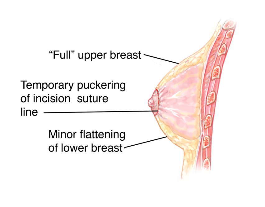 circumareolar breast lift