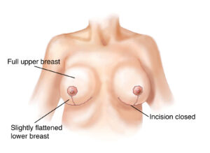  inverted-T breast lift 