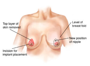 circumareolar breast lift 