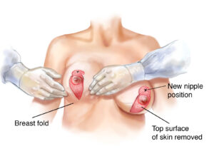 Vertical Breast Reduction: