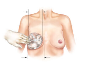 Breast implant sizing drawing esprit® cosmetic surgeons