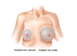 Breast implant sizing comparison drawing