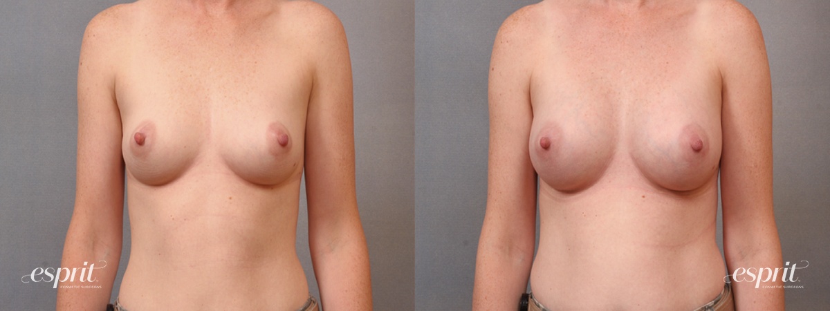 Case 1650 before and after front view esprit® cosmetic surgeons