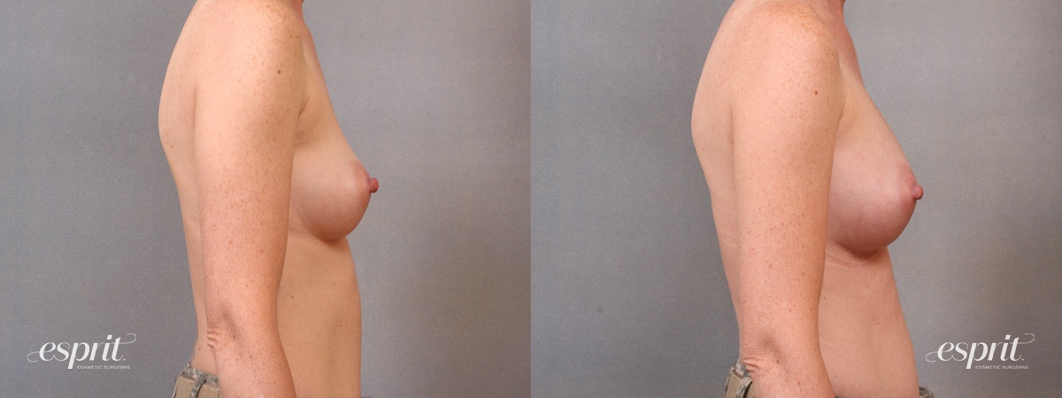 Case 1650 before and after right side view esprit® cosmetic surgeons