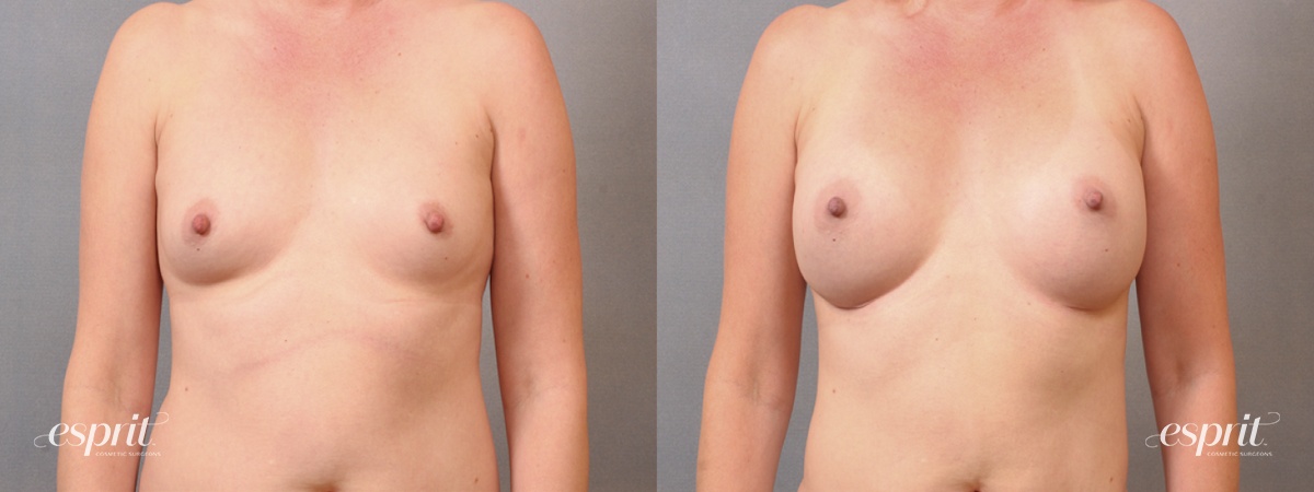 Case 1654 before and after front view esprit® cosmetic surgeons