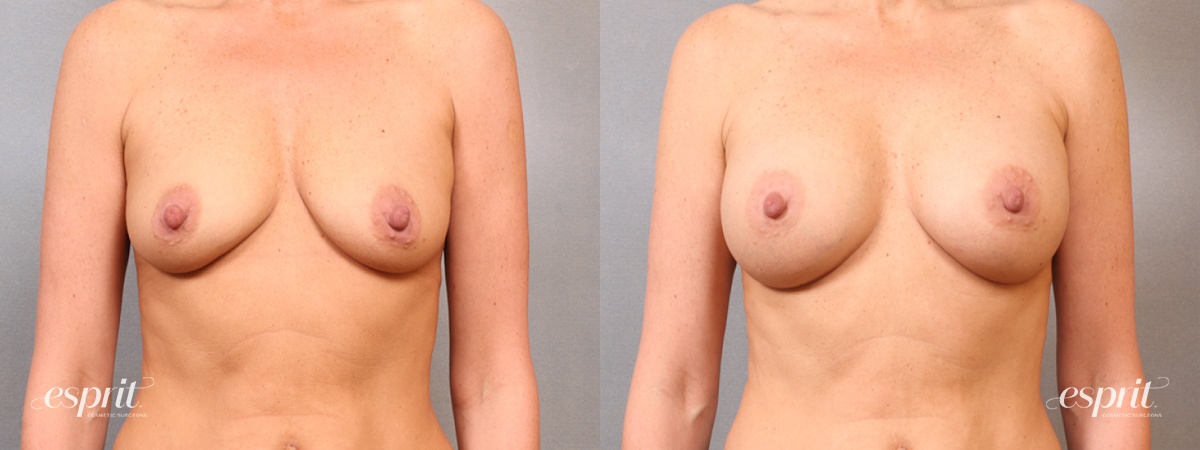 Case 1666 before and after front view esprit® cosmetic surgeons