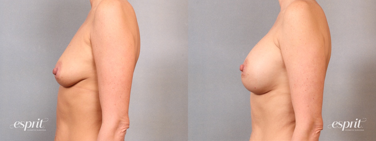 Case 1666 before and after left side view esprit® cosmetic surgeons