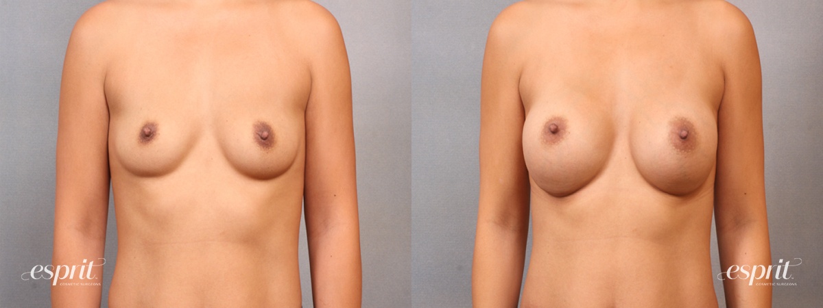 Case 1668 before and after front view esprit® cosmetic surgeons
