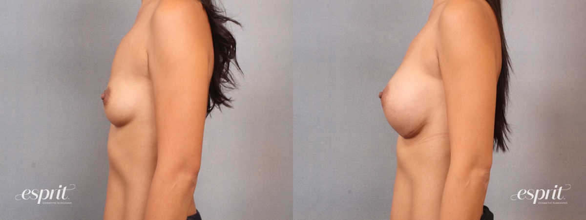 Case 1668 before and after left side view esprit® cosmetic surgeons
