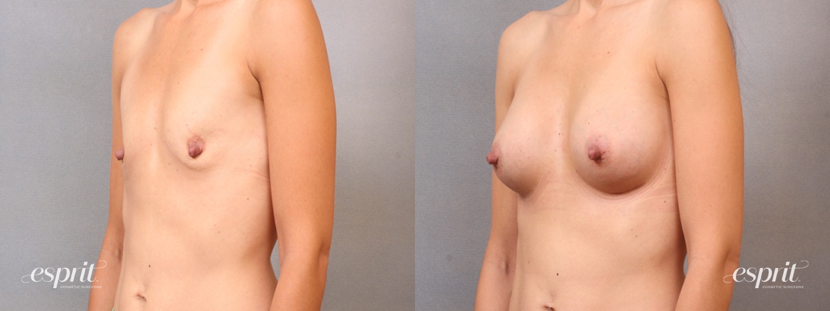 Case 1679 before and after left oblique view esprit® cosmetic surgeons