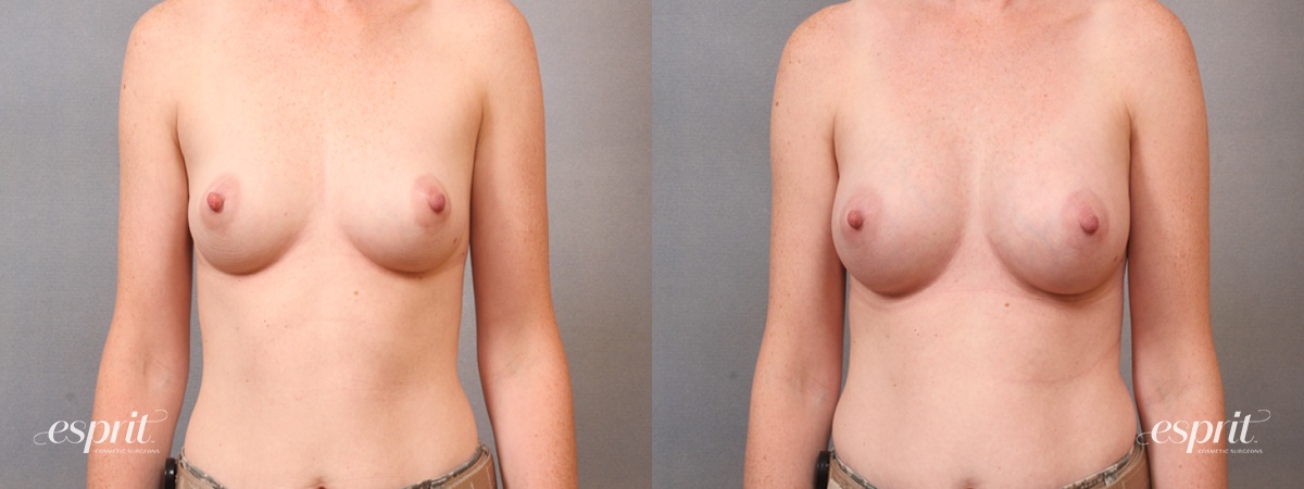 Case 1680 before and after front view esprit® cosmetic surgeons