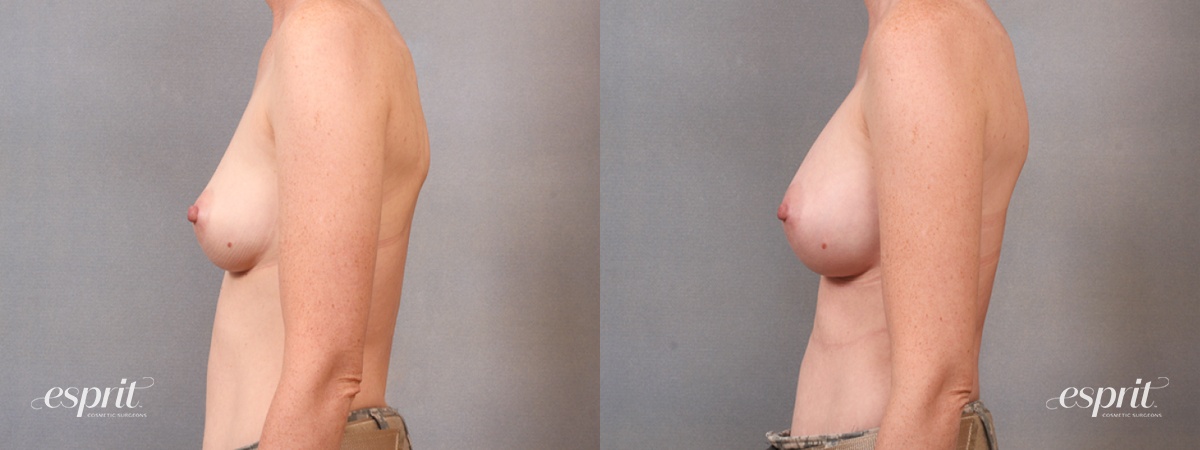 Case 1680 before and after left side view esprit® cosmetic surgeons