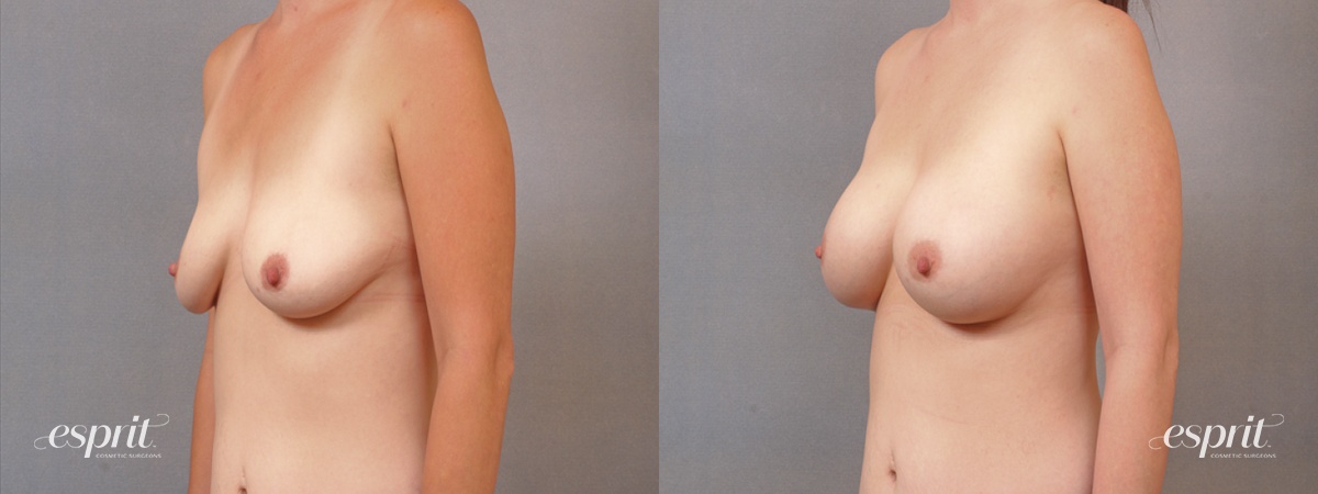 Case 1687 Before and After Left Oblique View