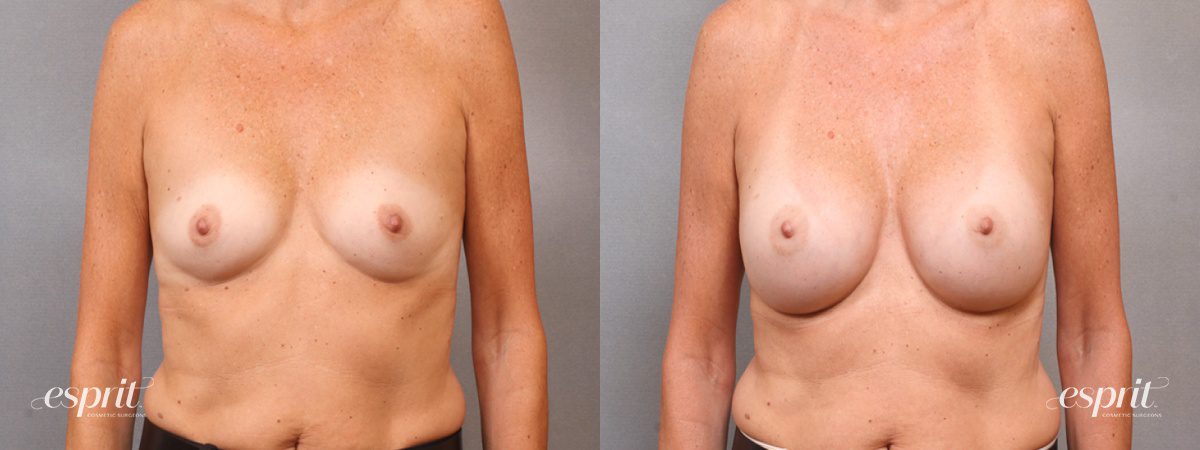 Case 1694 before and after front view esprit® cosmetic surgeons