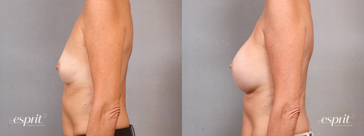 Case 1694 before and after left side view esprit® cosmetic surgeons