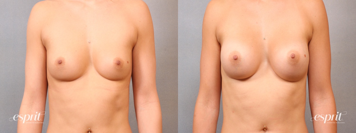 Case 1700 before and after front view esprit® cosmetic surgeons