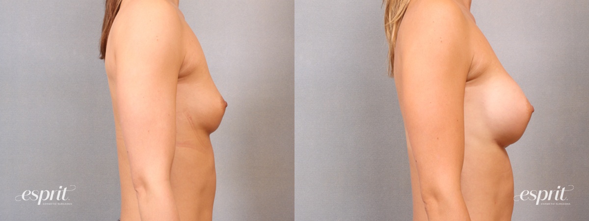 Case 1700 before and after right side view esprit® cosmetic surgeons