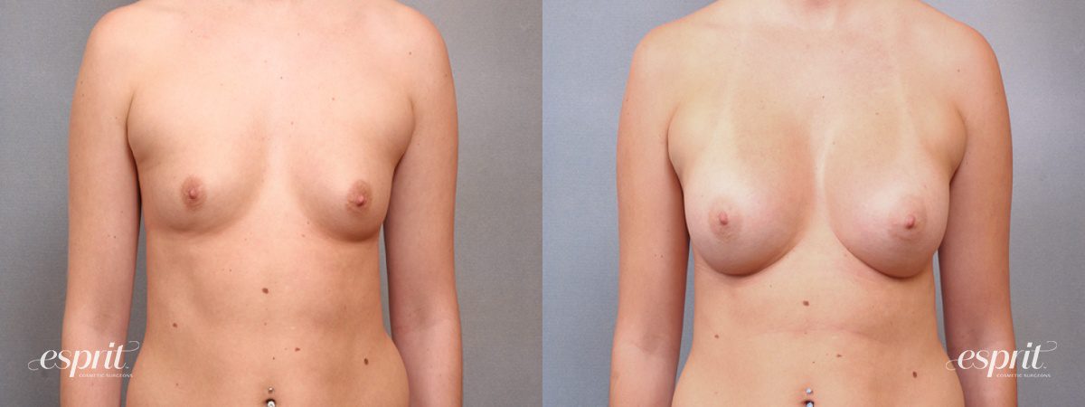 Case 1708 before and after front view esprit® cosmetic surgeons