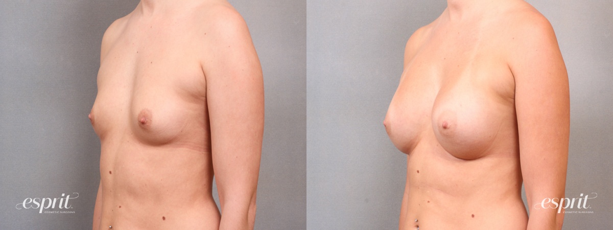 Case 1708 before and after left oblique view esprit® cosmetic surgeons