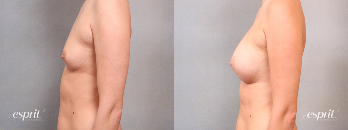 Case 1708 before and after left side view esprit® cosmetic surgeons