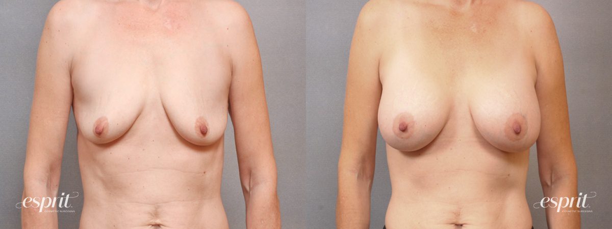 Case 1711 before and after front view esprit® cosmetic surgeons