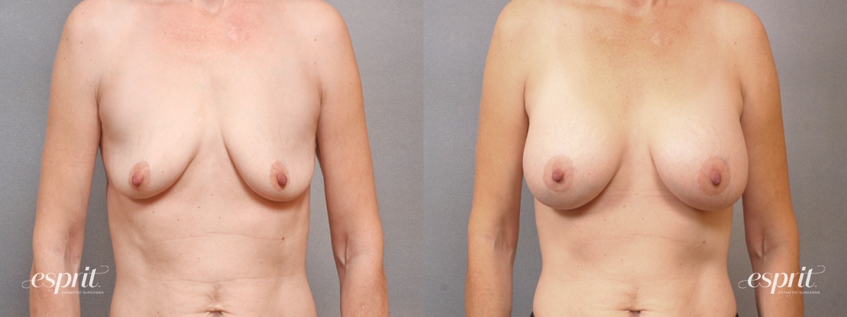 Case 1711 before and after front view esprit® cosmetic surgeons