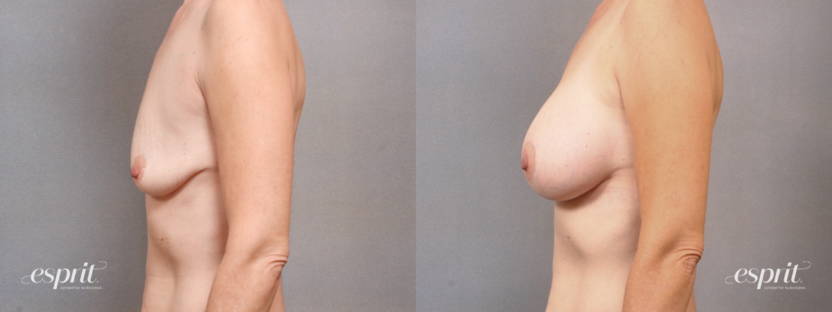 Case 1711 before and after left side view esprit® cosmetic surgeons