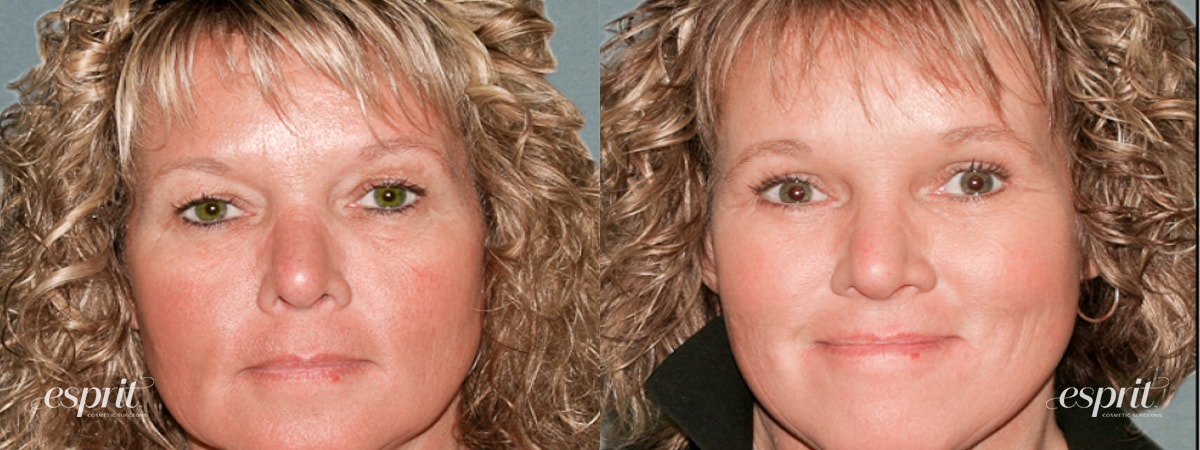 Case 1216 before and after front view esprit® cosmetic surgeons
