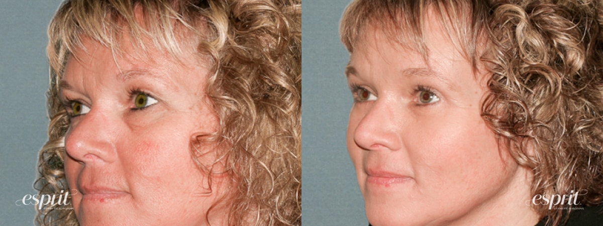 Case 1216 before and after left oblique view esprit® cosmetic surgeons
