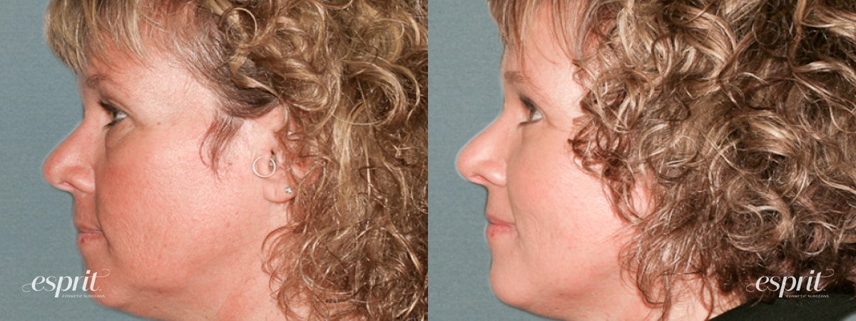 Case 1216 before and after left side view esprit® cosmetic surgeons