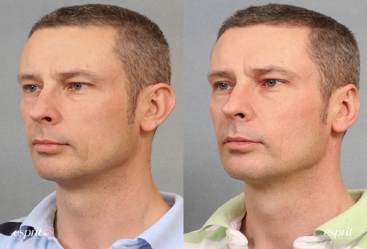 Case 1505 before and after left oblique view esprit® cosmetic surgeons