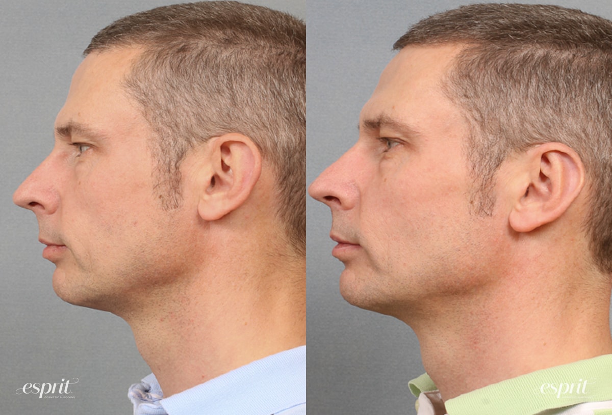 Case 1505 before and after left side view esprit® cosmetic surgeons