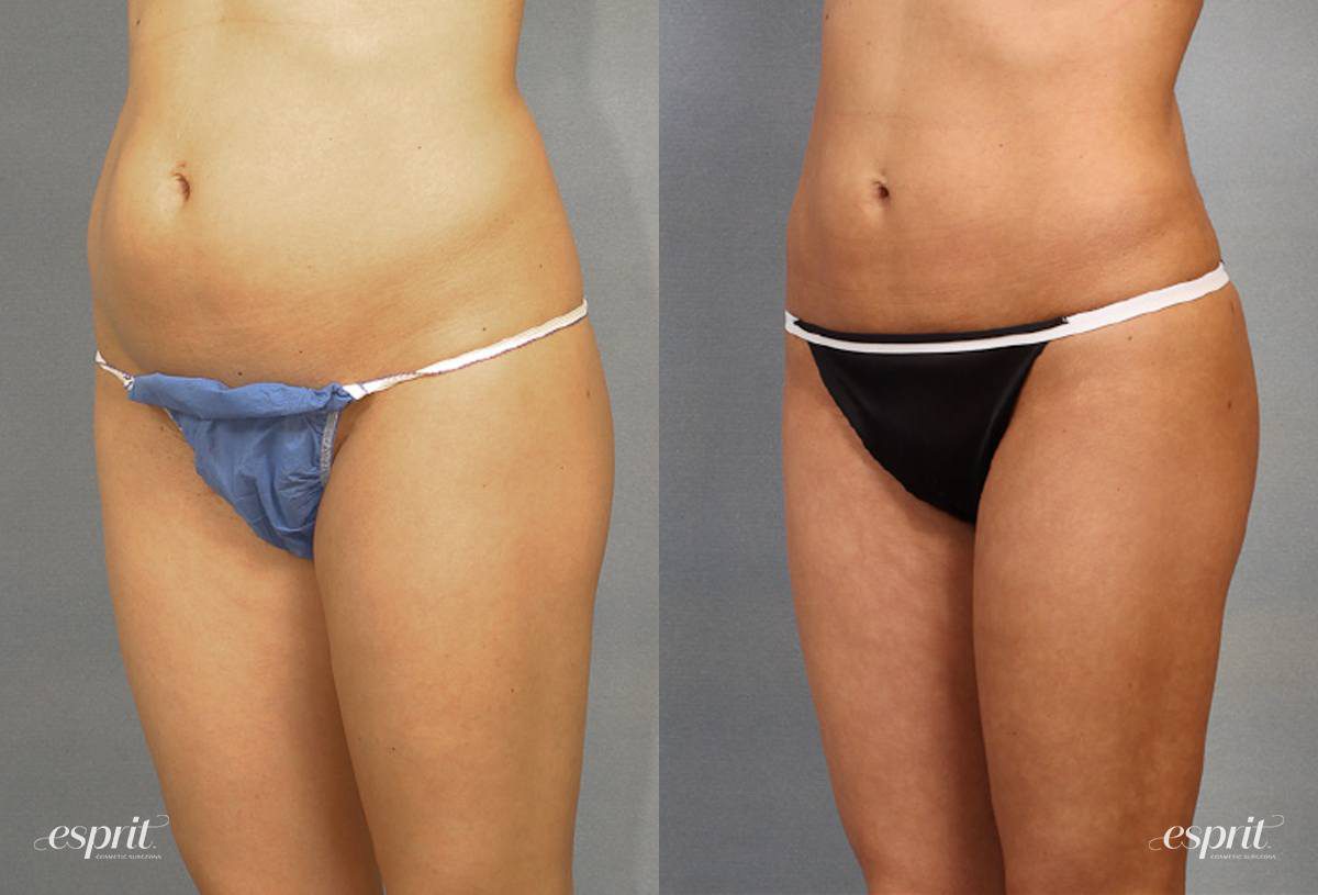 Case 1544 before and after left oblique view esprit® cosmetic surgeons