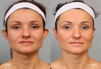 Case 1557 before and after front view esprit® cosmetic surgeons