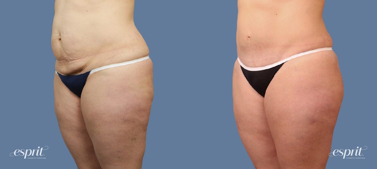 Case 1593 before and after left oblique view esprit® cosmetic surgeons