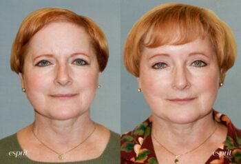 Case 1187 before and after front view esprit® cosmetic surgeons