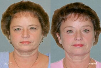 Case 1219 before and after front view esprit® cosmetic surgeons