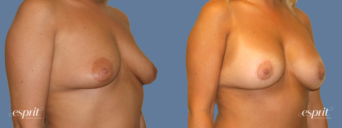 Case 1304 Before and After Right Oblique View