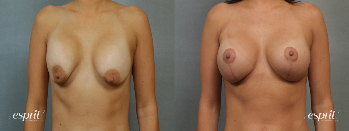 Case 1361 before and after front view esprit® cosmetic surgeons