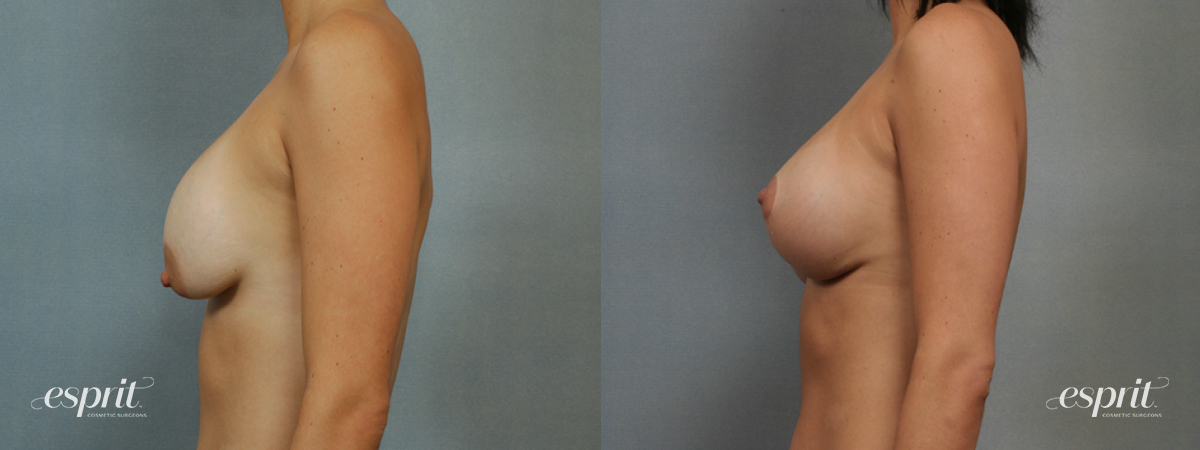 Case 1361 before and after left side view esprit® cosmetic surgeons