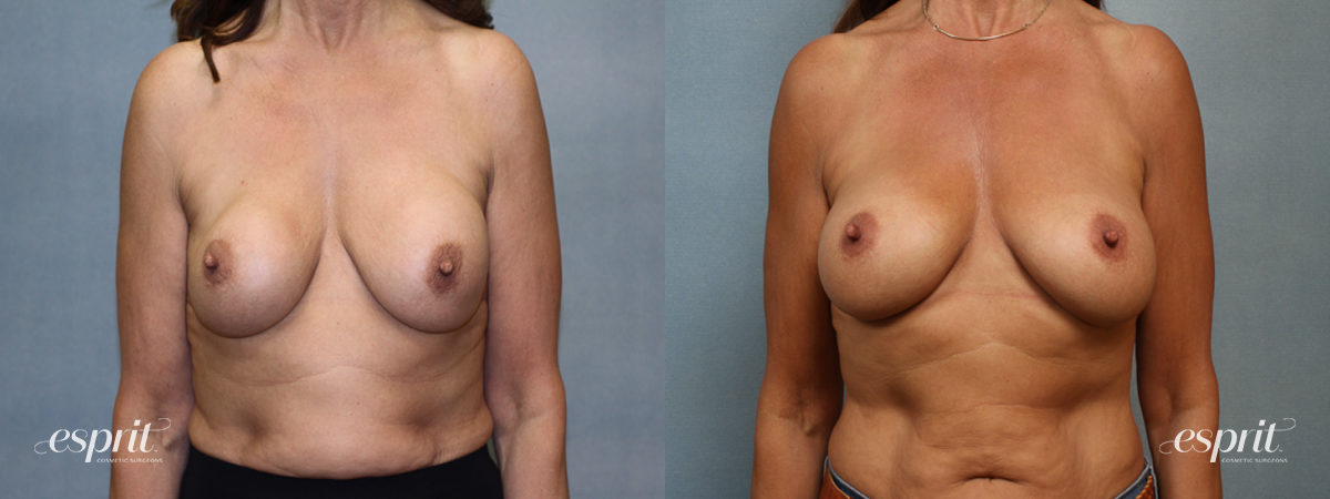 Case 1369 before and after front view esprit® cosmetic surgeons
