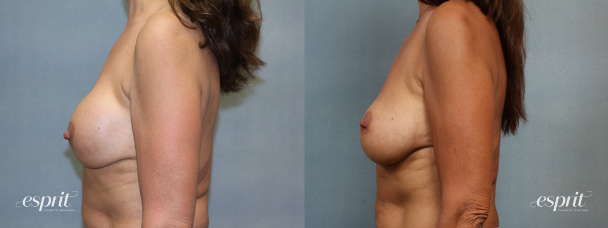 Case 1369 before and after left side view esprit® cosmetic surgeons