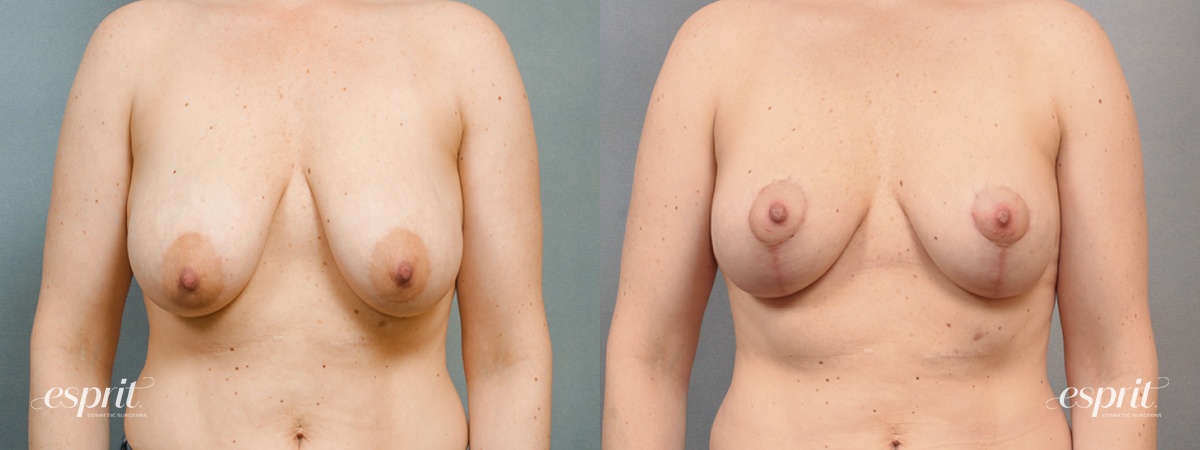 Case 1445 before and after front view esprit® cosmetic surgeons