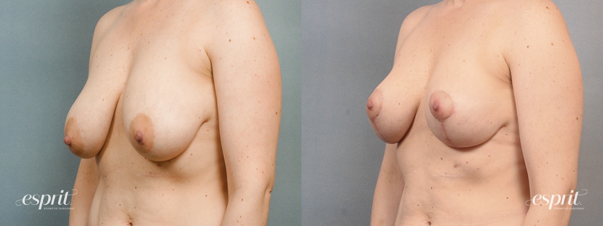 Case 1445 before and after left oblique view esprit® cosmetic surgeons