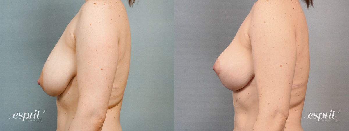 Case 1445 before and after left side view esprit® cosmetic surgeons