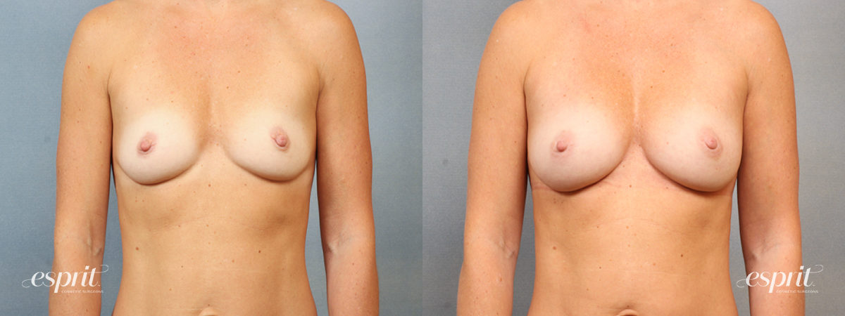 Case 1461 before and after front view esprit® cosmetic surgeons