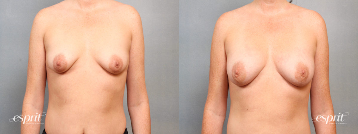 Case 1515 before and after front view esprit® cosmetic surgeons