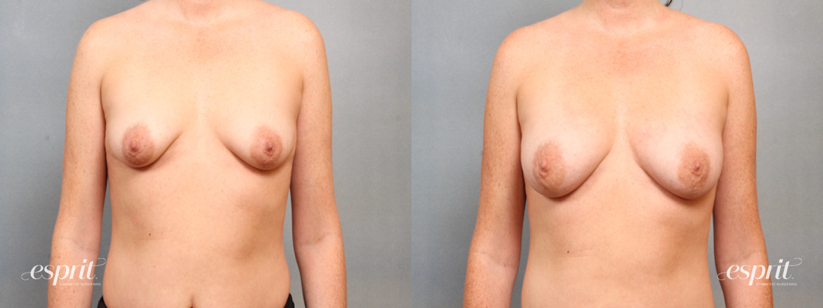 Case 1515 before and after front view esprit® cosmetic surgeons