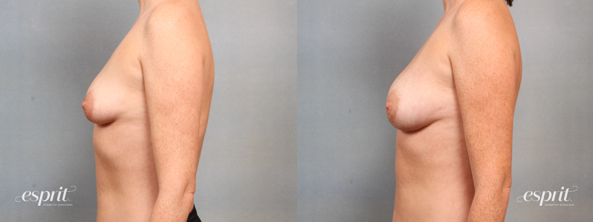 Case 1515 before and after left side view esprit® cosmetic surgeons